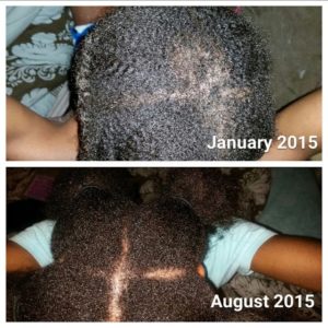 How I Made A Come Back The Right Way And Reversed My Severe Crown Breakage