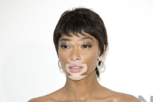 How ANTM’s Winnie Harlow Inspires Us To Remain Positive