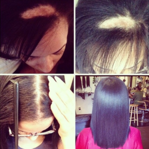 My Experience With Traction Alopecia