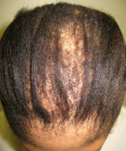 A Relaxer To Deal With Central Cetrifugal Cicatrical Alopecia?