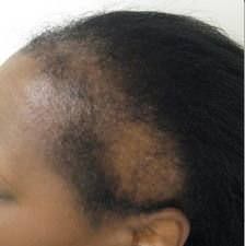 How to Stop Hair Line and Root Damage Due to Protective Styles
