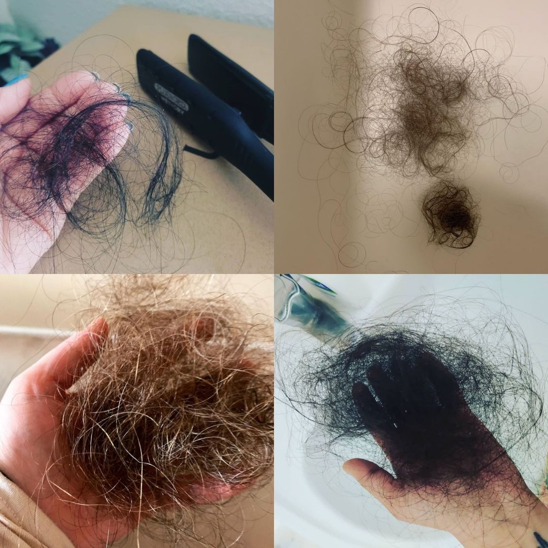 People Sharing Their COVID Hair Loss on Instagram