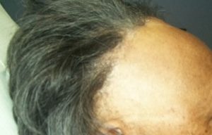 Major Breakthrough For Persons Suffering From Alopecia: Scientists Create Fabulous Cure