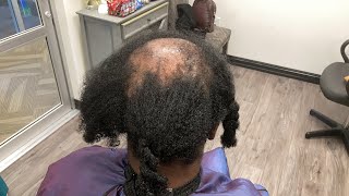 Invisible Ponytail To Hide My Clients Balding And Thinning