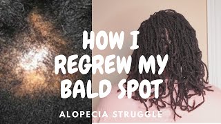How I Regrew My Bald Spot / Alopecia And Locs