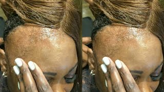 I Feel So Bad For So Many Women Who Don'T Know Better | Extreme Alopecia Hair Makeover | Hair L