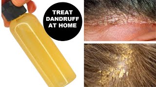 Dandruff, Dry Scalp, How To Treat And Get Rid Of Dandruff + Dry Scalp At Home