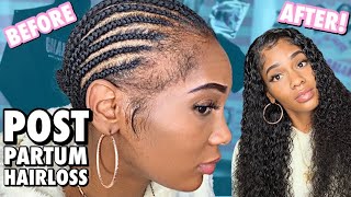 Fighting Postpartum Hair Loss Invisible 5X5 Hd Lace Closure Wig Install Ft. Supernova Hair