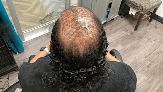 How To Add Extensions When You Have Alopecia