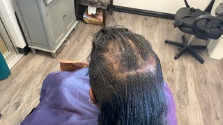 She Hasn’T Had A Trim In Years| She Has Alopecia In The Entire Crown Of Her Head