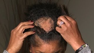 What Is Causing This Woman’S Extreme Hair Loss?