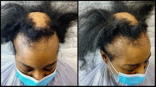 Alopecia Hair Makeover | How To Cover Bald Spots For Women | Alopecia Hair Transformation