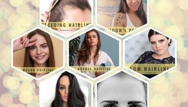 Different Types of Hairlines for Women