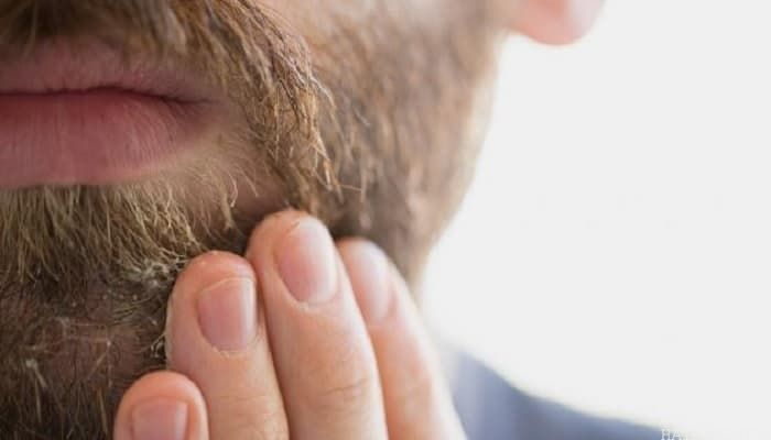 Causes of Beard Dandruff