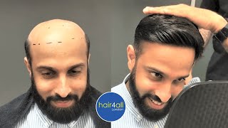 Before & After | Hair System | Non-Surgical Hair Replacement System Men/Women | Uk/Usa/International