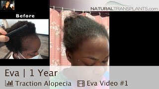 Traction Alopecia Hair Loss Treatment For Women Result | Hair Transplant For Women, Dr Huebner (Eva)