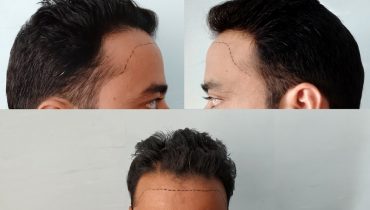 Can You Really Fix A Messed Up Hairline?