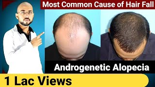 Most Common Cause Of Hair Fall In Men & Women | Hair Fall Solution At Home | Hereditary Hair Loss