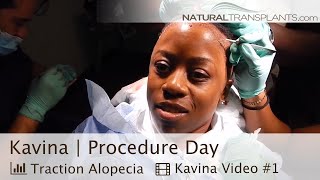 African American Hair Transplant | Hair Transplant Women (Kavina)
