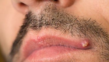 Ingrown Beard Hair: Cuases, Symptomps & Remedies