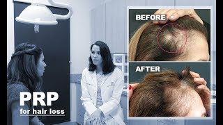 Women Hair Loss Stories | How Prp Naturally Stimulates Hair Growth