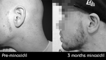 Minoxidil (or Rogaine) Works for Beard Growth: Fact or Myth?
