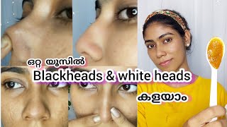 How To Remove Blackheads/ Whiteheads Easily At Home  Malayalam | Nerin