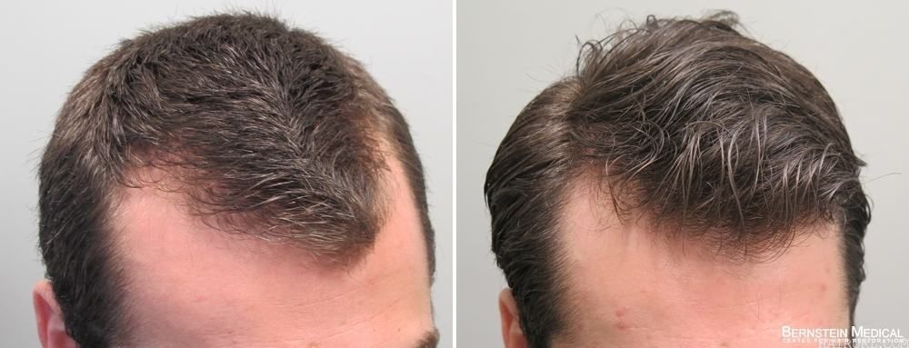 Rogaine Minoxidil effect before and after