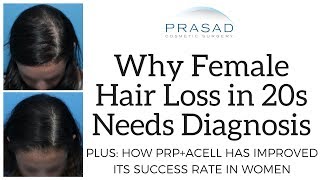 Why Hair Loss In Women In The 20S Needs Diagnosis, And Improved Success Rate Of Acell+Prp Treatment