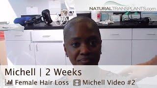 Hair Implants For Women, 2 Week Followup | Hair Loss In Women (Michell)