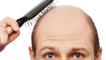 Receding Hairline: Signs & Treatment