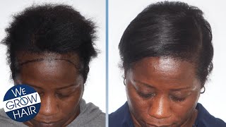 Hair Transplant For African American Women And Men