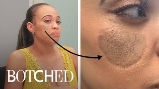 Dog Bite Victim Has "Pubic Hair" Growing On Her Face | Botched | E!