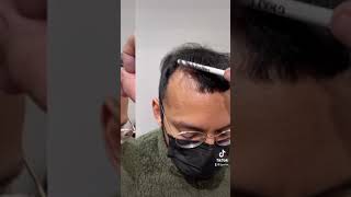 The Future Hairloss Solution To Baldness