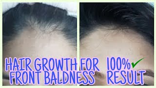 Hair Growth For Front Baldness // 7 Days Challenge // 100% ✅ Result // In Tamil // Kattrina Dey //