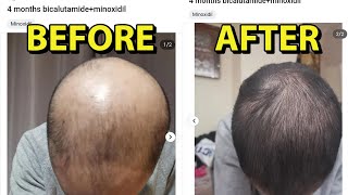 The One Hair Loss Reversal Treatment That Works 99.9% But Most Aren'T Willing To Do!