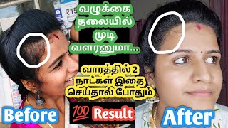 How I Cured My Baldness/How To Grow Hair Fast In Tamil/How To Promote Hair Growth In Bald Areas