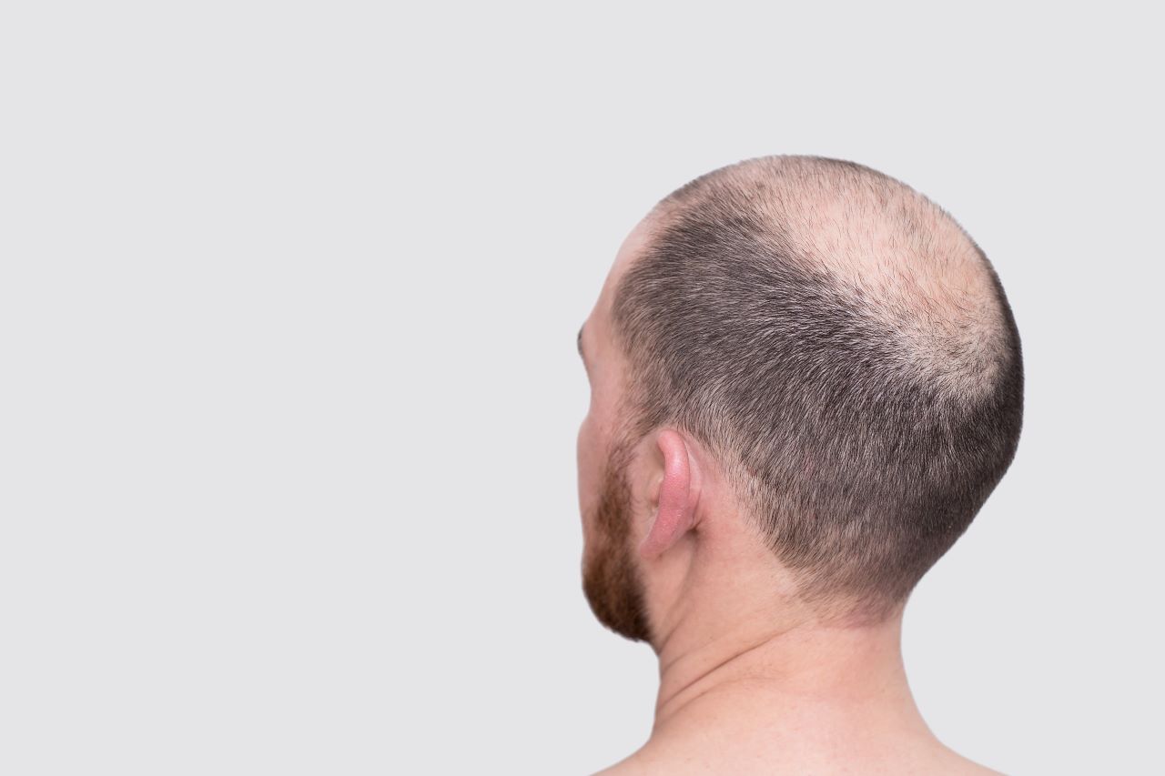 Do I need to protect my scalp when wearing a hair system?