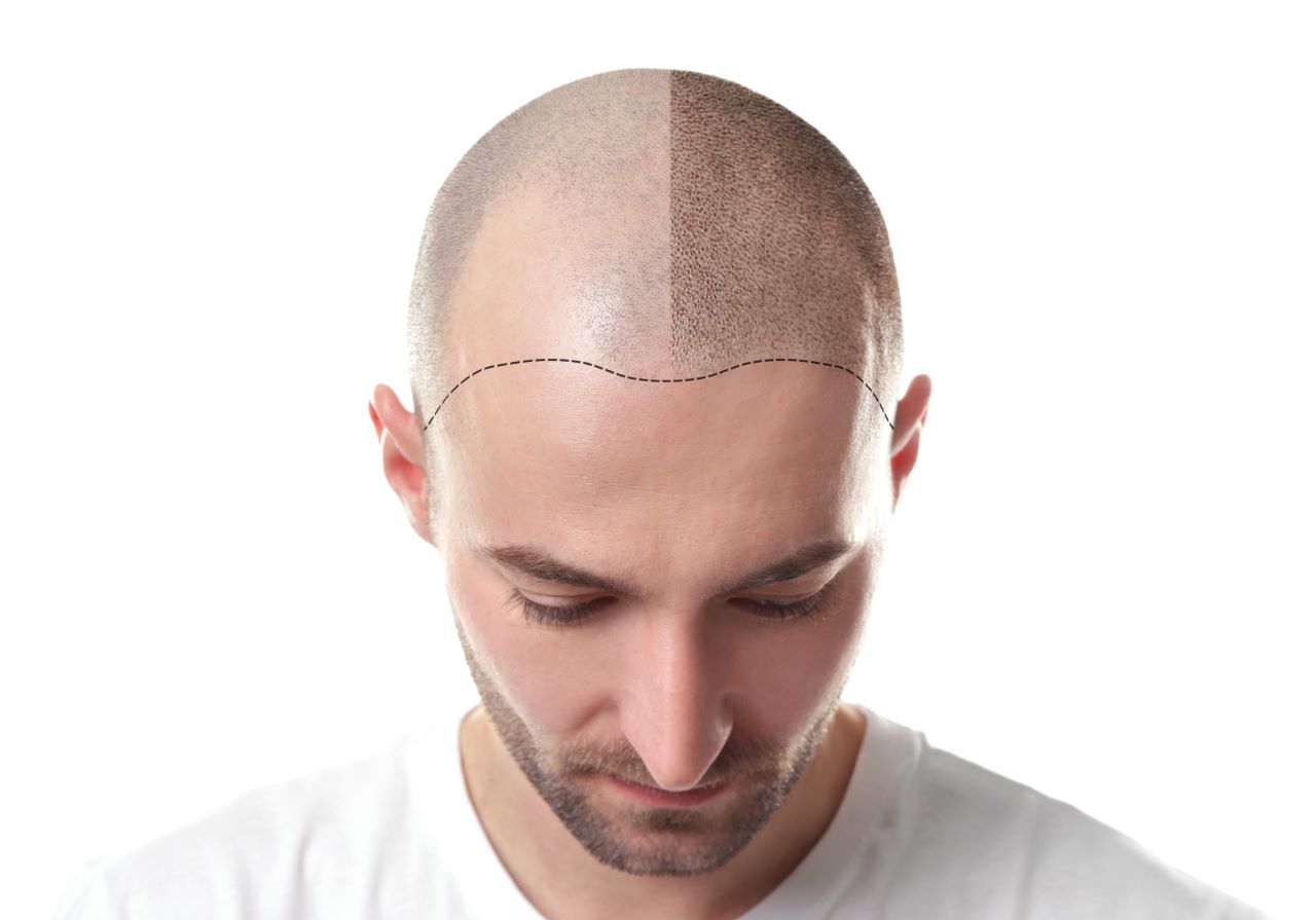Hair transplant versus hairpiece – which is better for me?