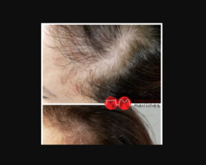 Signs of Hair Loss: Symptoms and Causes