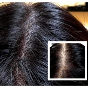 Can Women Get Scalp Micropigmentation and Is It Worth It?