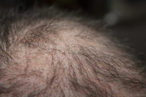 Understanding the Phases of Hairloss