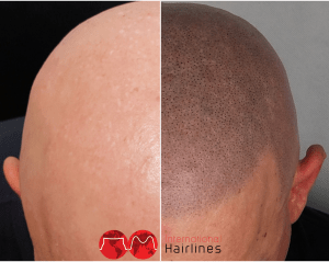 Differences Between FUE vs FUT Hair Transplant