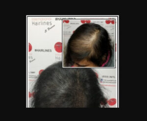 What is the Best Treatment for Female Pattern Baldness?