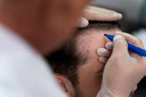 Can I Combine a Hair Tattoo with a Hair Transplant?