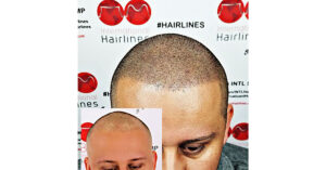 Does Micro Scalp Pigmentation Look Real?