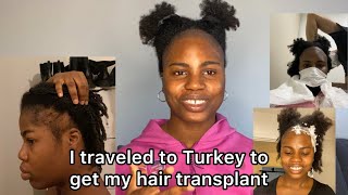 Cure For Balding Edges | Fue Hair Transplant For Black Women, Afro Hair | Longevita Turkey