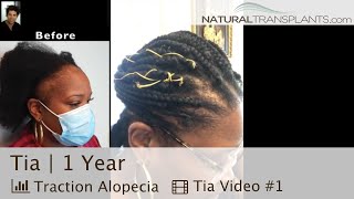 Traction Alopecia Hair Transplantation For Black Women | Dr. Matt Huebner (Tia)