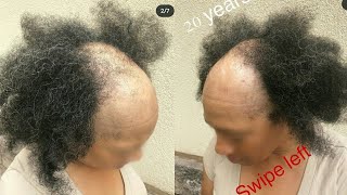 This Is One Super Gorgeous Transformation Not To Miss, She Walked Out Extremely Happy,  Hair Loss