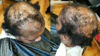 Want To See Something Breathtaking ! Checkout This Severe Alopecia Hair Makeover, Hair Loss Makeover